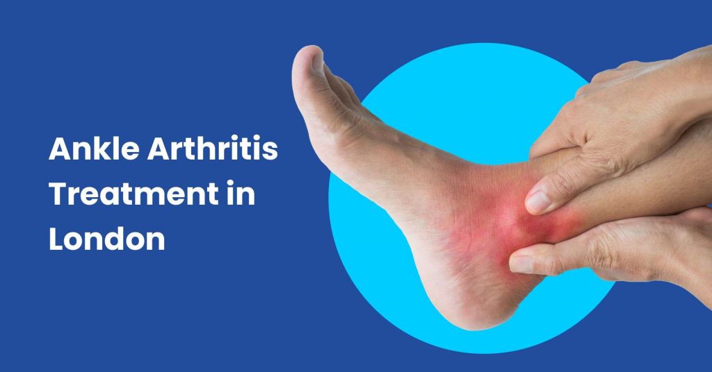 Ankle Arthritis Treatment in London