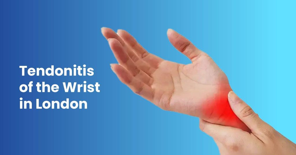 Tendonitis Wrist in London